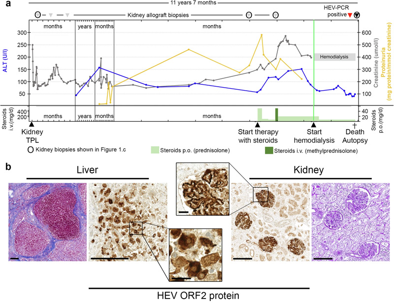 
戊型肝炎腎移植受者膜增殖型免疫復合物腎小球腎炎的臨床過程、尸檢結(jié)果和逐漸發(fā)展