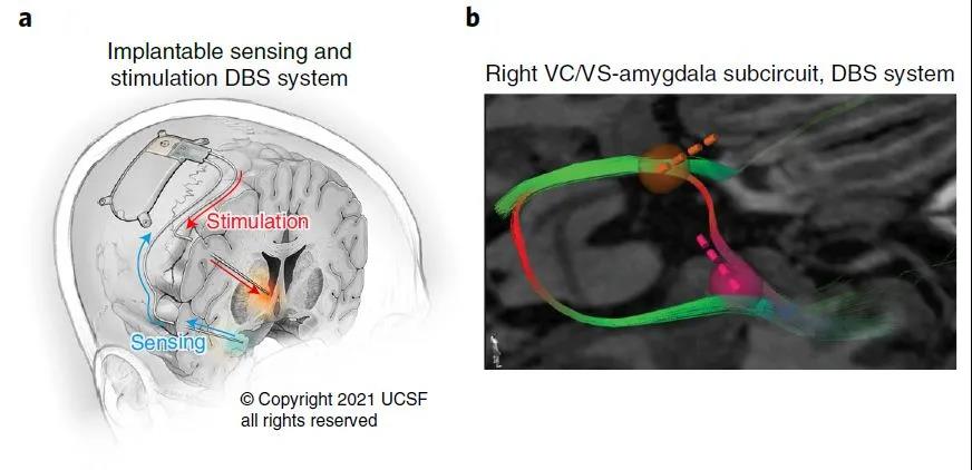 腦電刺激成功拯救重度抑郁癥患者，治愈抑郁癥時代離我們不遠(yuǎn)了？