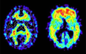 新冠帶來(lái)新的“醫(yī)療壓力”：阿爾茨海默病的風(fēng)險(xiǎn)飆升50%-80%