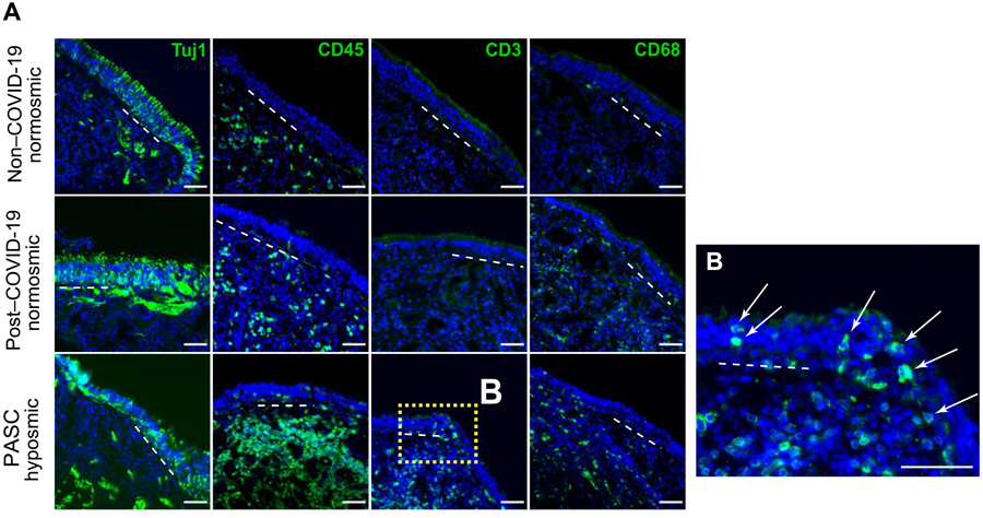 新冠肺炎急性后遺癥嗅覺粘膜下丘組織學(xué)評估提示T細胞浸潤的作用