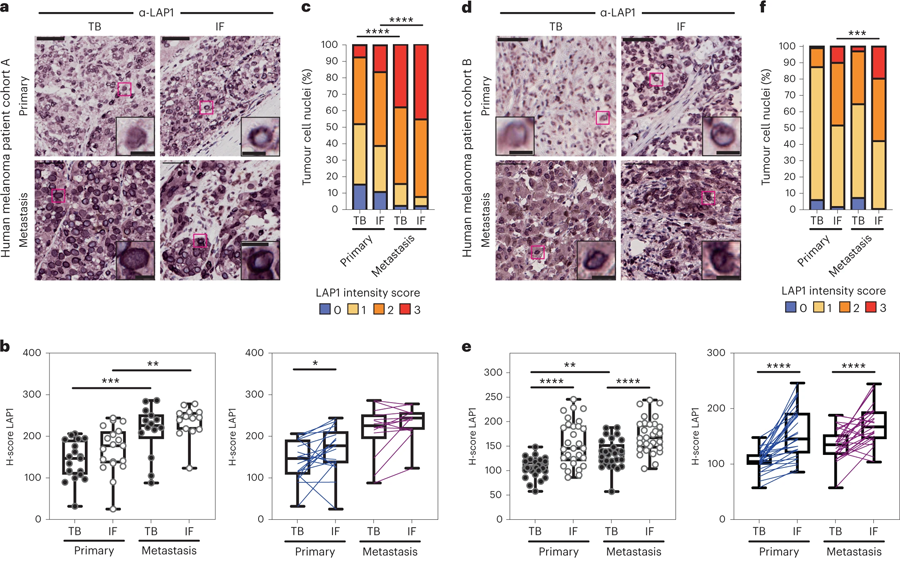 LAP1水平在人類(lèi)黑色素瘤進(jìn)展中增加