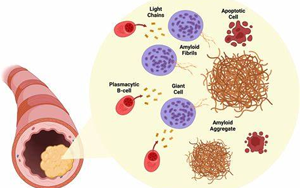NEJM綜述：淀粉樣變性的發(fā)病機(jī)制、研究和治療