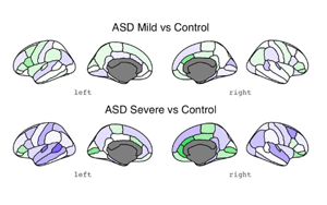 自閉癥最早的生物學(xué)跡象